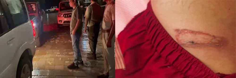 राजस्थान-बीकानेर में अनाथ को महिला रिश्तेदार ने चिमटे से दागा, स्कूल प्रिंसिपल की शिकायत पर मामला दर्ज